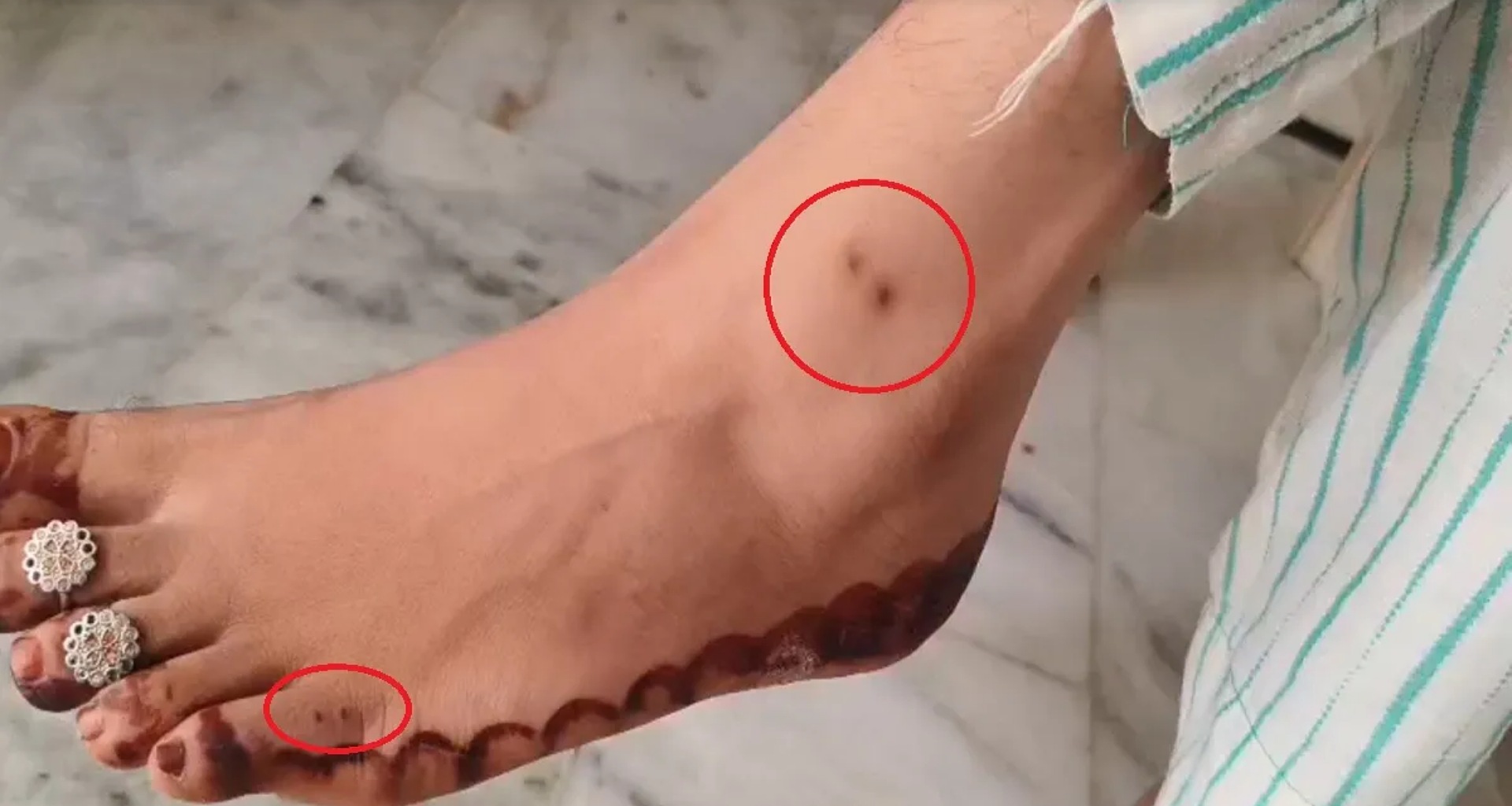 પાલીમાં, એક પરિણીત મહિલાને 6 મહિનામાં 7મી વખત સાપે કરડ્યો, છતાં તે જીવિત છે... તેની સારવાર કરતા ડોકટરો પણ આશ્ચર્યચકિત