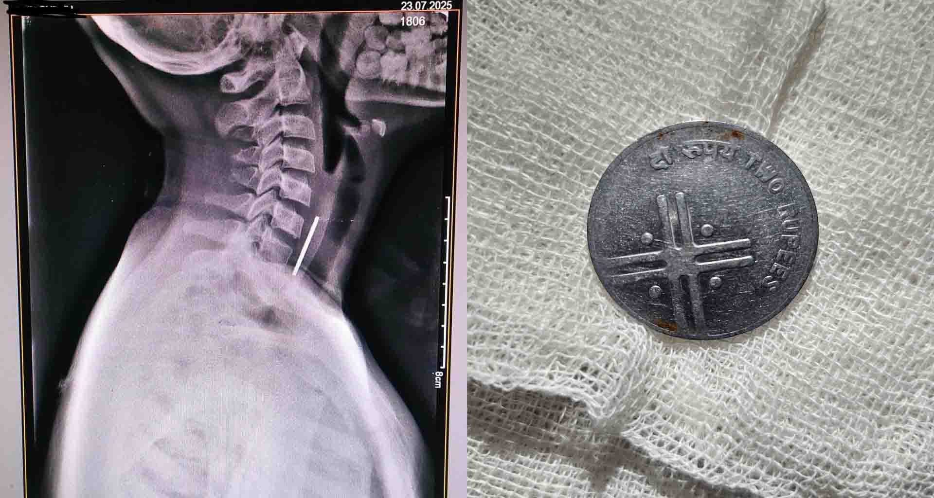 બાલીસણા ના 13 વર્ષીય માસુમ બાળકની અન્નનળી માં ફસાયેલ સિક્કાને સિફત પૂવૅક કાઢતા ધારપુરના તબીબ