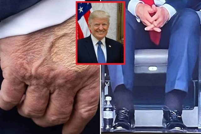 ટ્રમ્પના પગમાં સોજો આવવાની અટકળો વચ્ચે વ્હાઇટ હાઉસે જણાવ્યું હતું કે તેમને ક્રોનિક નસની બીમારી હોવાનું નિદાન થયું