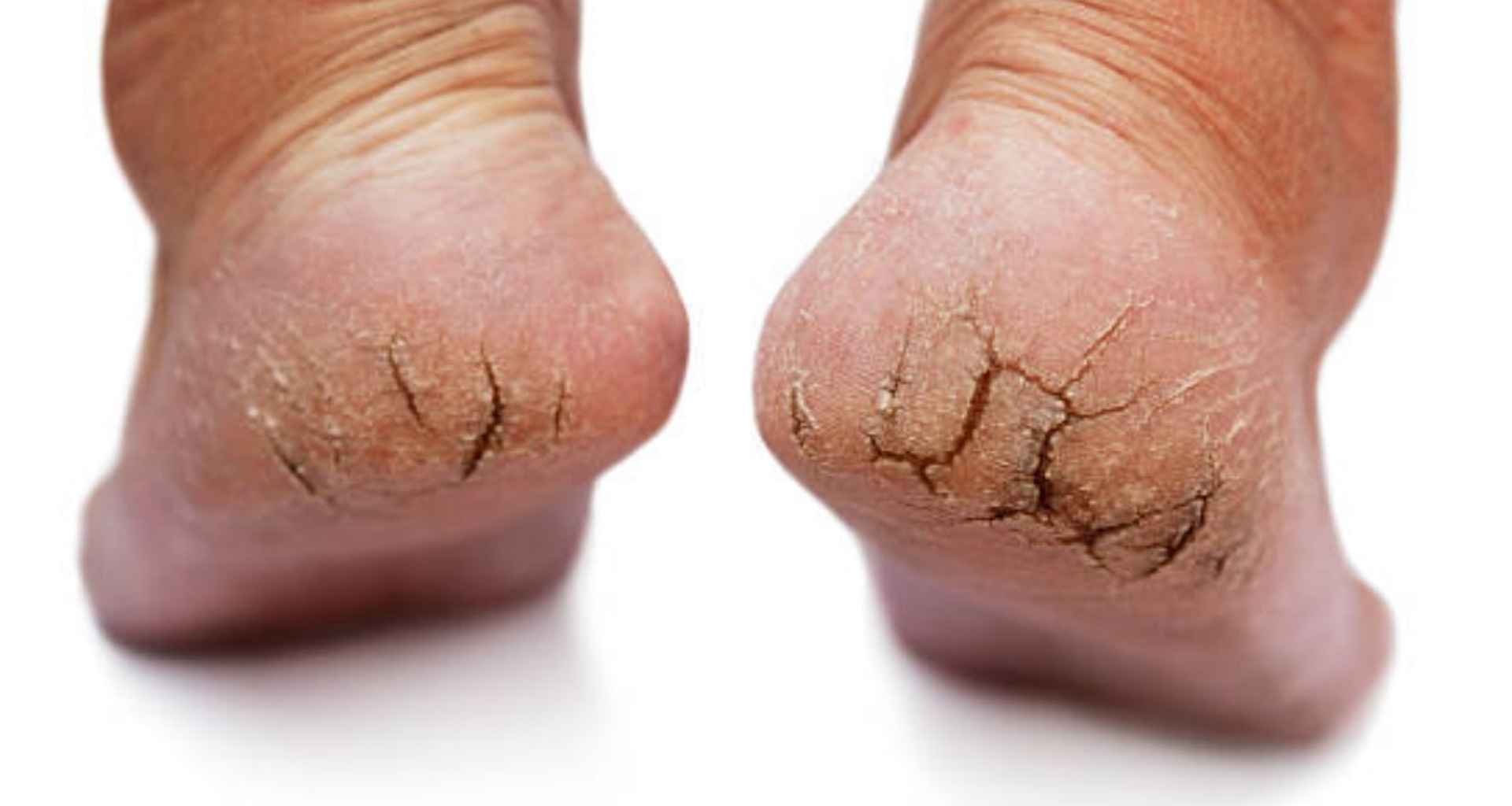 શું તમારા પગમાં વાઢિયા પડ્યા છે ? તો અજમાવો આ ટિપ્સ