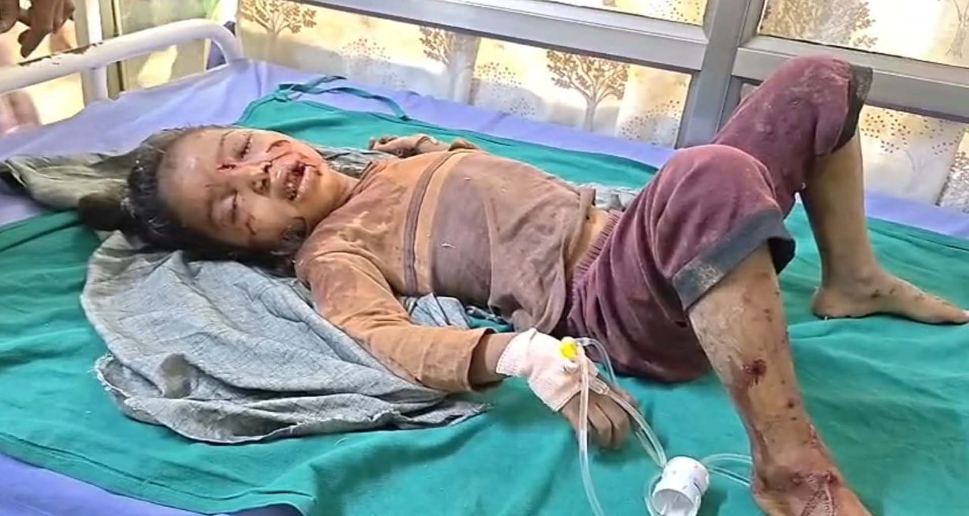 ડીસાના ભોપાનગરમાં રખડતા ભૂંડનો આતંક : 5 વર્ષની બાળકી પર જીવલેણ હુમલો