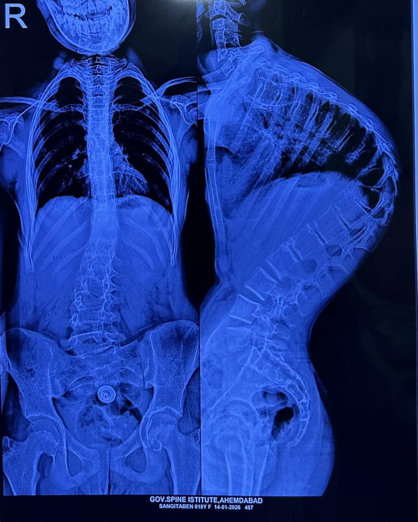 કરોડરજ્જુની અત્યંત જોખમી ‘કાઇફોસ્કોલિયોસિસ’ સર્જરી અમદાવાદમાં સફળતાપૂર્વક સંપન્ન