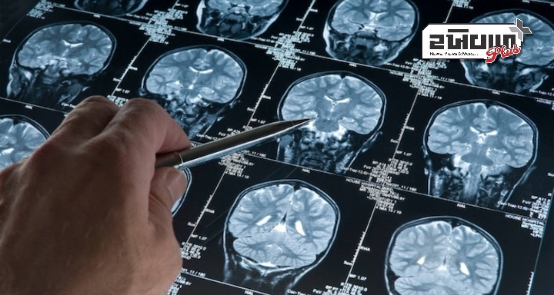 અલ્ઝાઈમર રોગ તમારા મગજમાં થતા ફેરફારોનું જોખમ વધારે હોવાનું સૂચવી શકે છે