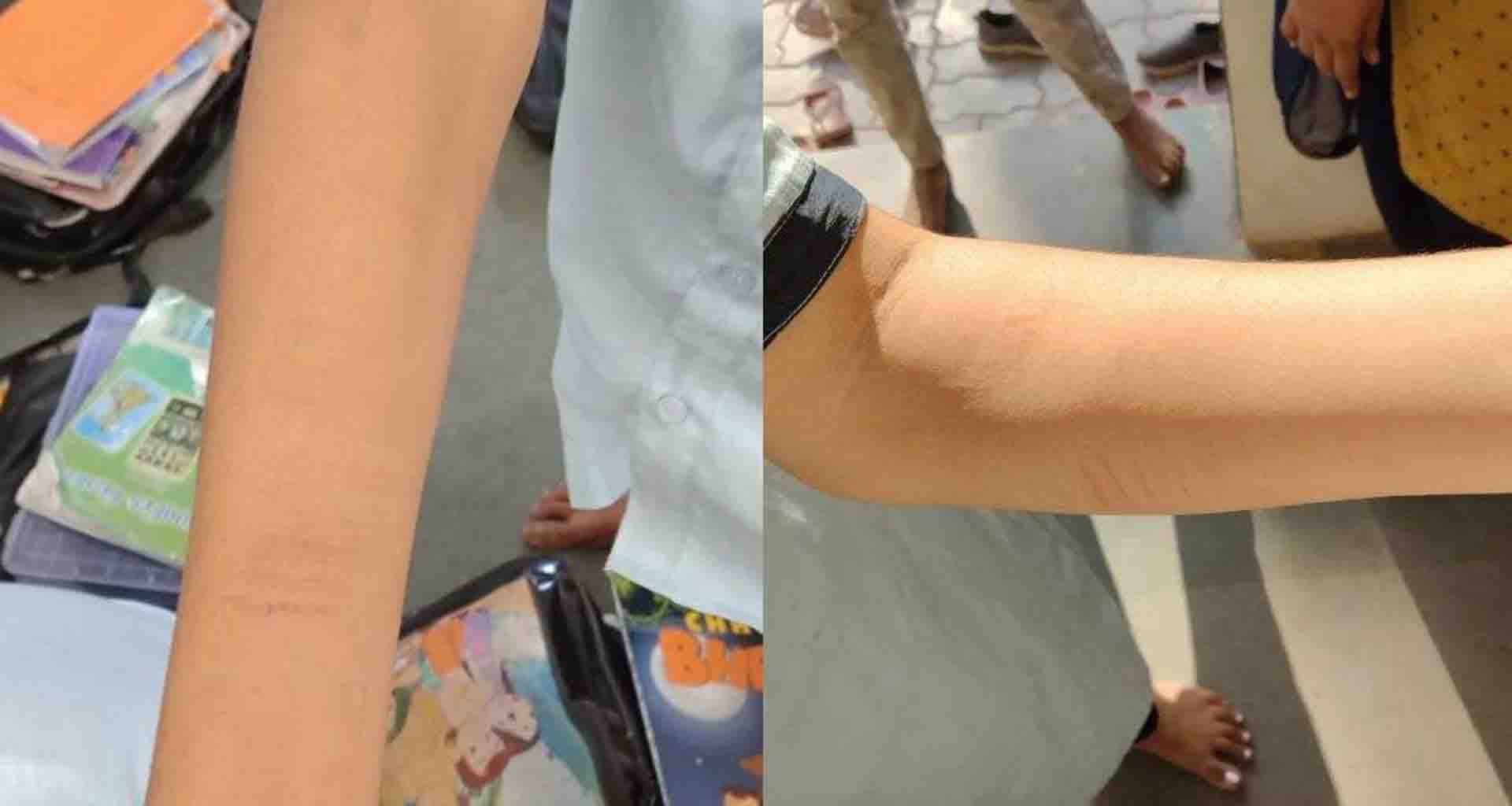 પ્રાથમિક શાળામાં વિચિત્ર ઘટના; છાત્રોને હાથ પર બ્લેડના કાપા