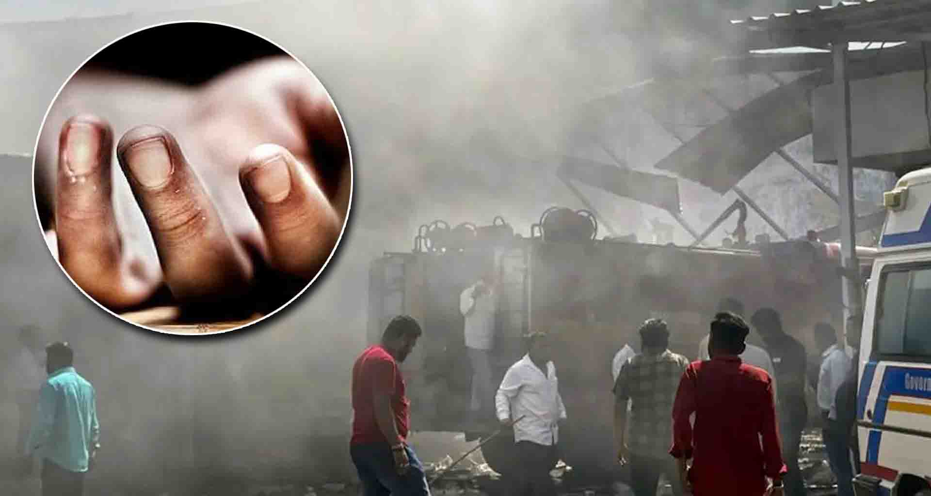 ડીસા બ્લાસ્ટ કેસ; અમદાવાદ સિવિલ હોસ્પિટલમાં સારવાર લઈ રહેલા મધ્યપ્રદેશના 23 વર્ષીય યુવાન નું મોત